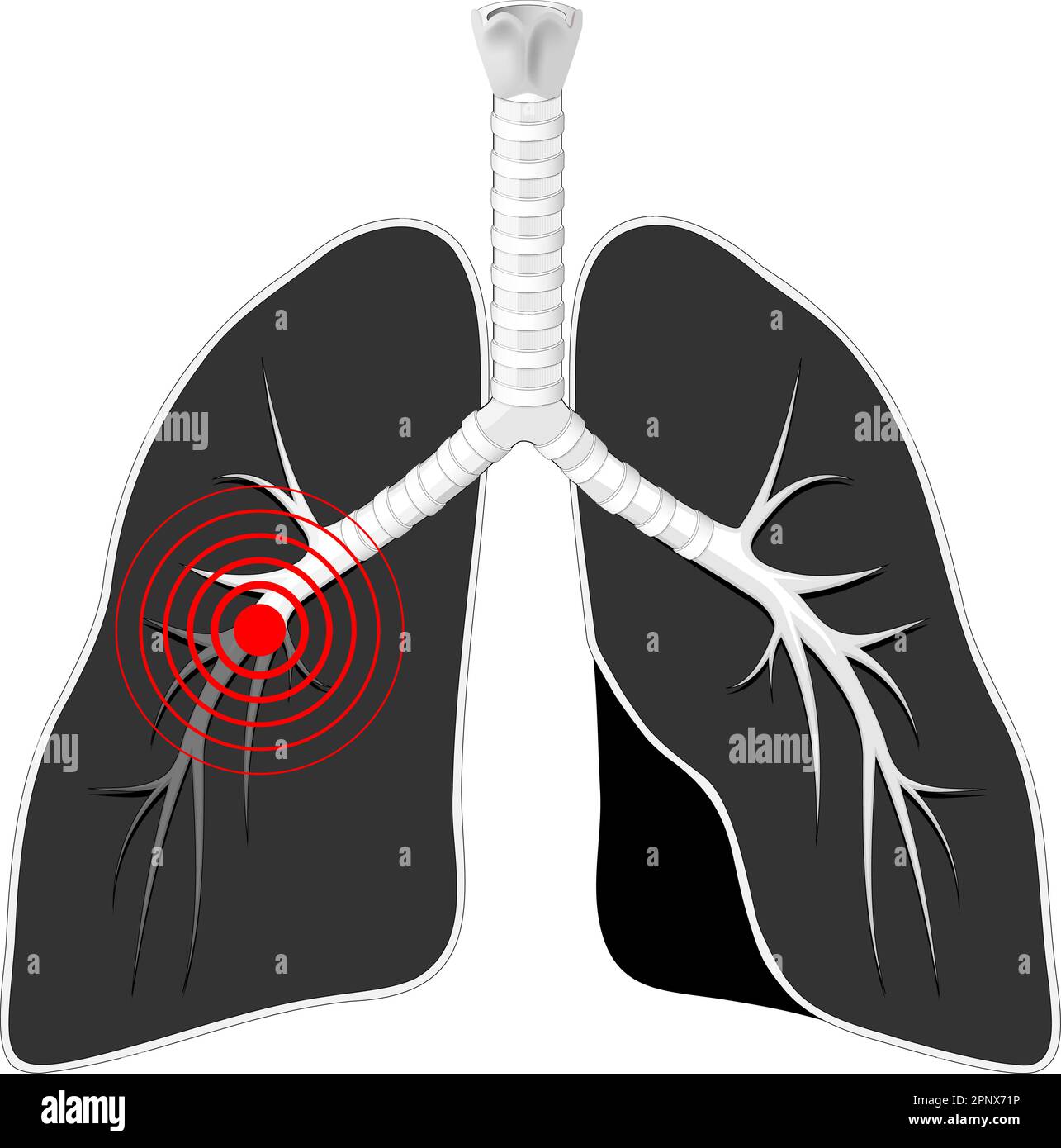 Lungs disease. Black lungs with bronchi and red mark on white background. Human Respiratory system. Vector illustration Stock Vector