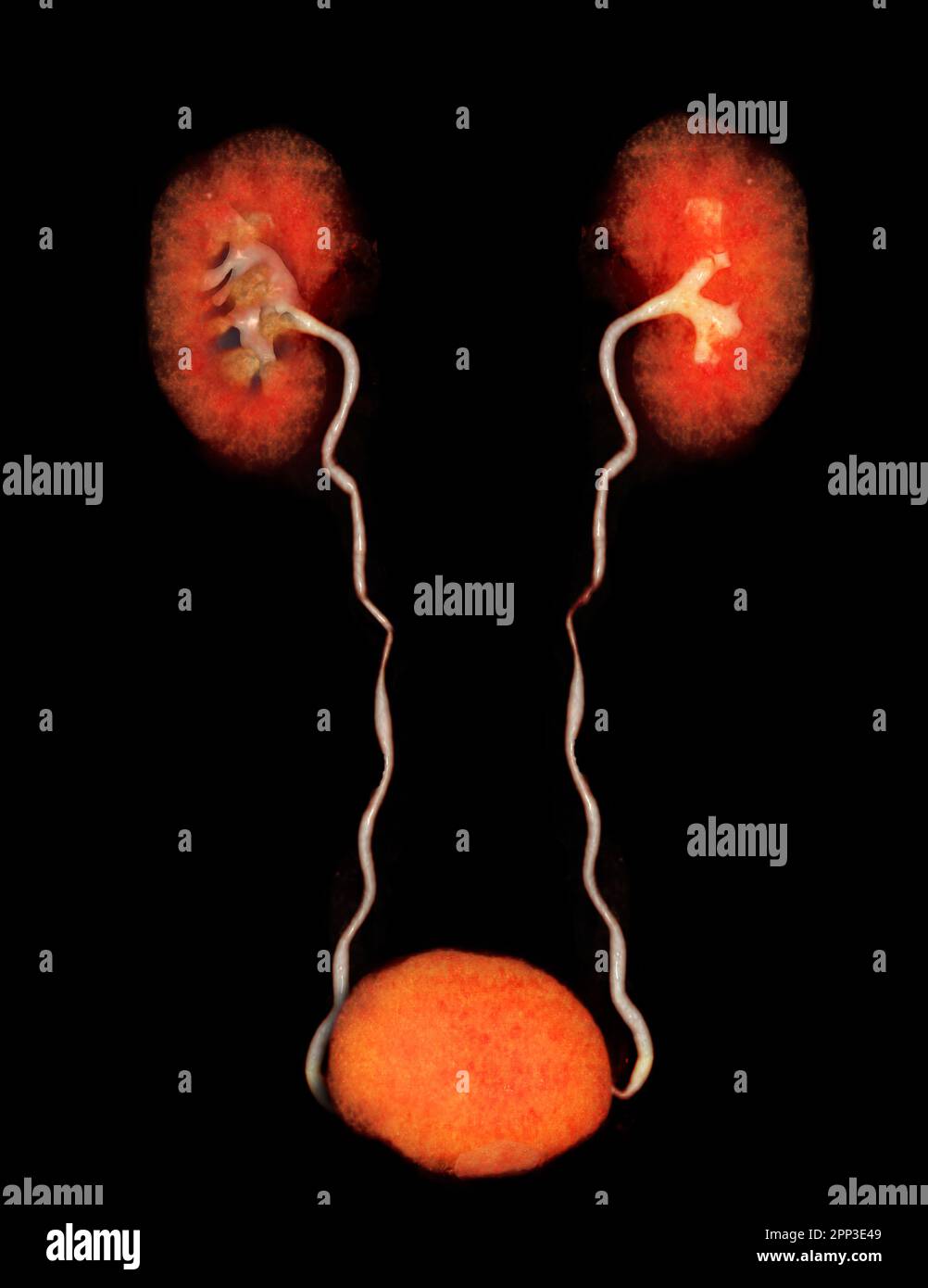 CTA Renal artery  3D rendering image  showing both kidney, Ureter and bladder . Stock Photo