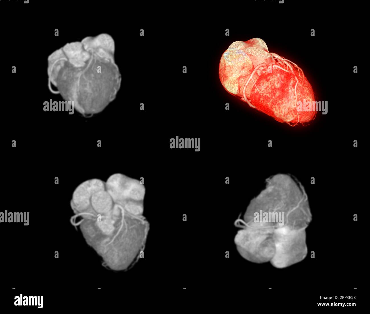 CTA Coronary artery  3D rendering image. Stock Photo