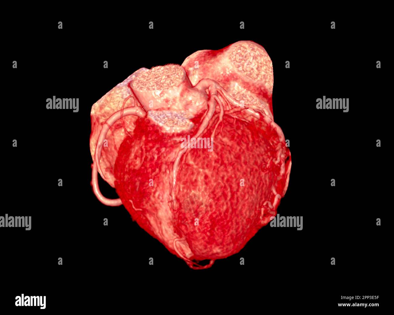 CTA Coronary artery  3D rendering image. Stock Photo
