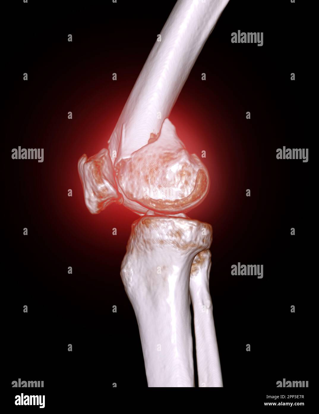 CT scan of knee joint 3D rendering image  showing fracture of distal femur bone. Stock Photo