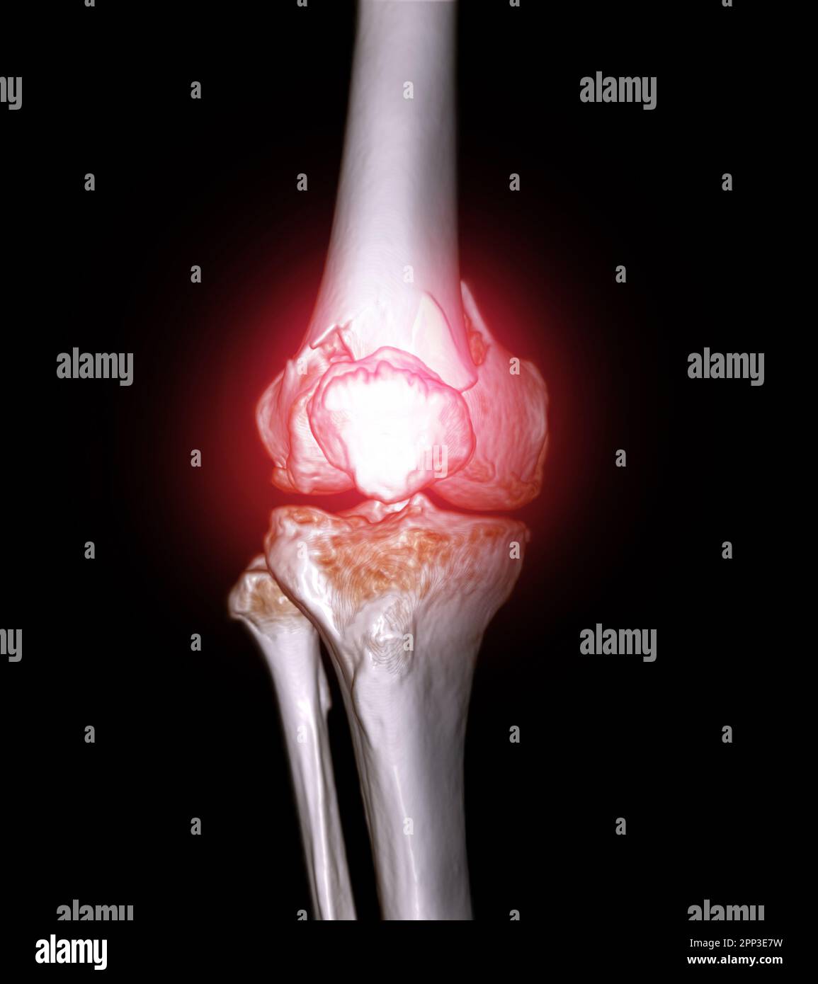 CT scan of knee joint 3D rendering image  showing fracture of distal femur bone. Stock Photo