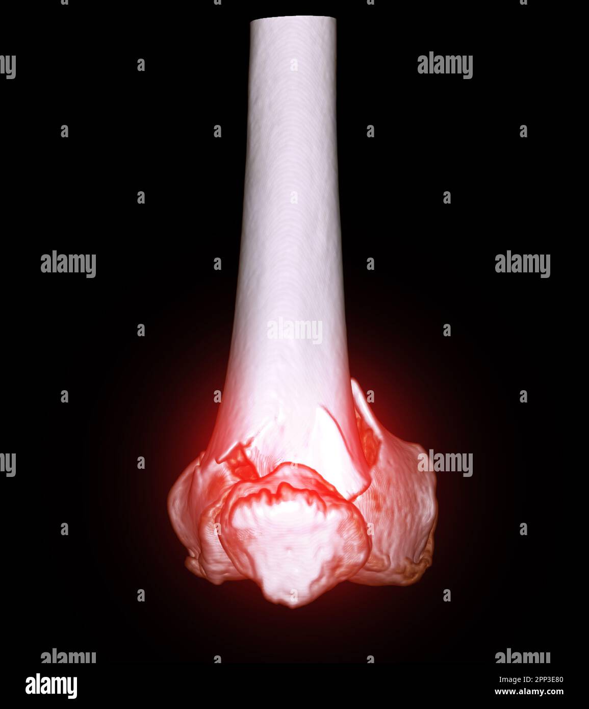 CT scan of knee joint 3D rendering image  showing fracture of distal femur bone. Stock Photo