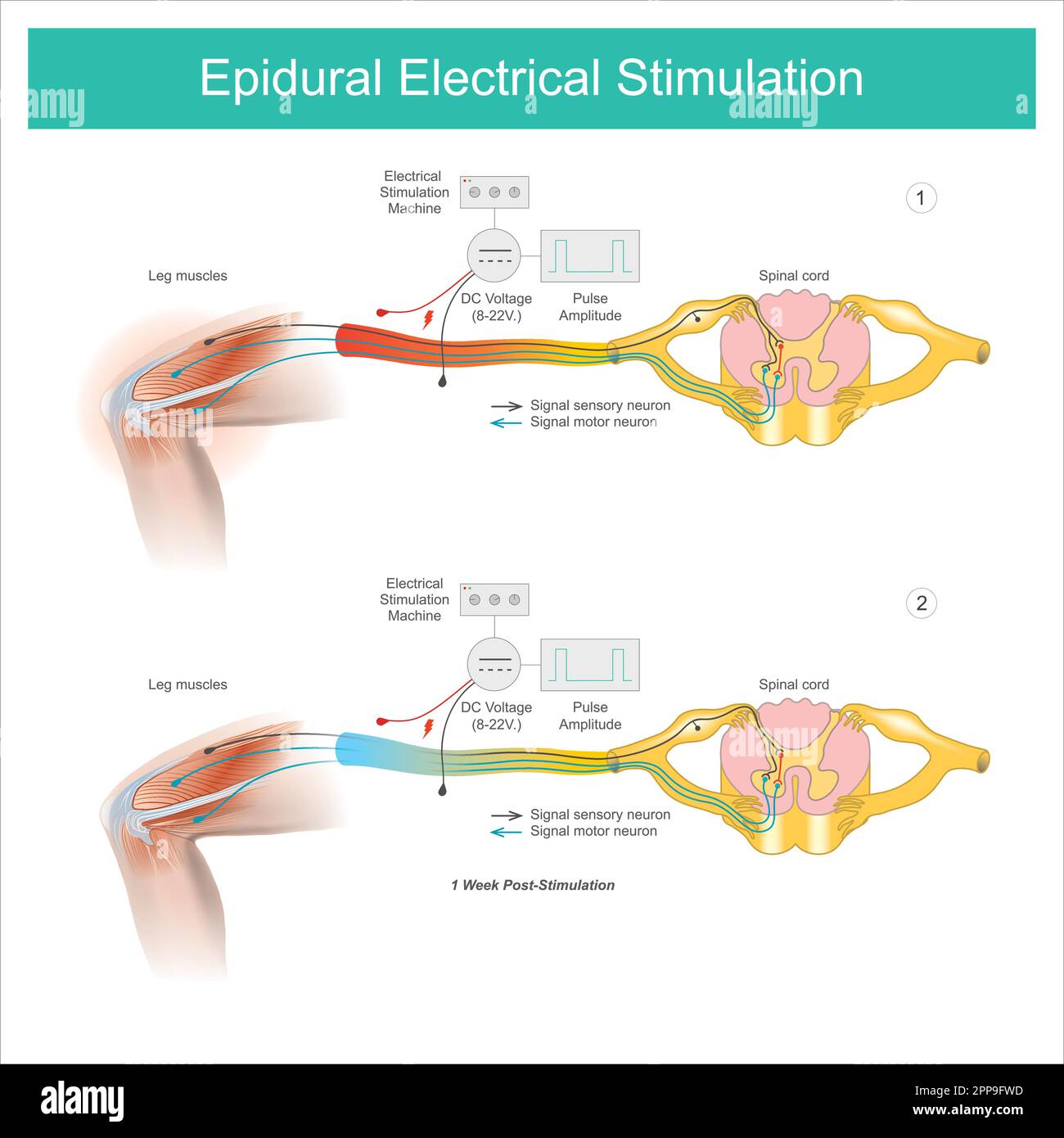 Epidural Electrical Stimulation. Muscle pain symptom in the leg area