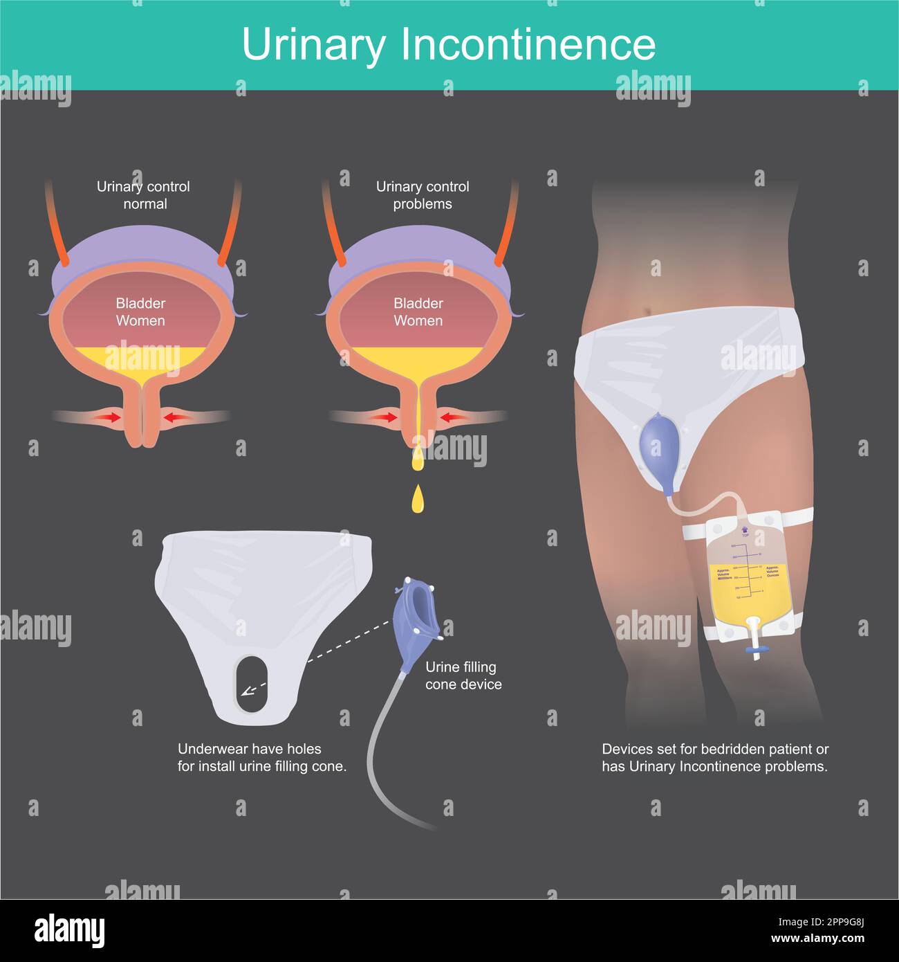 Urinary Incontinence. Urine filling cone device for bedridden patient