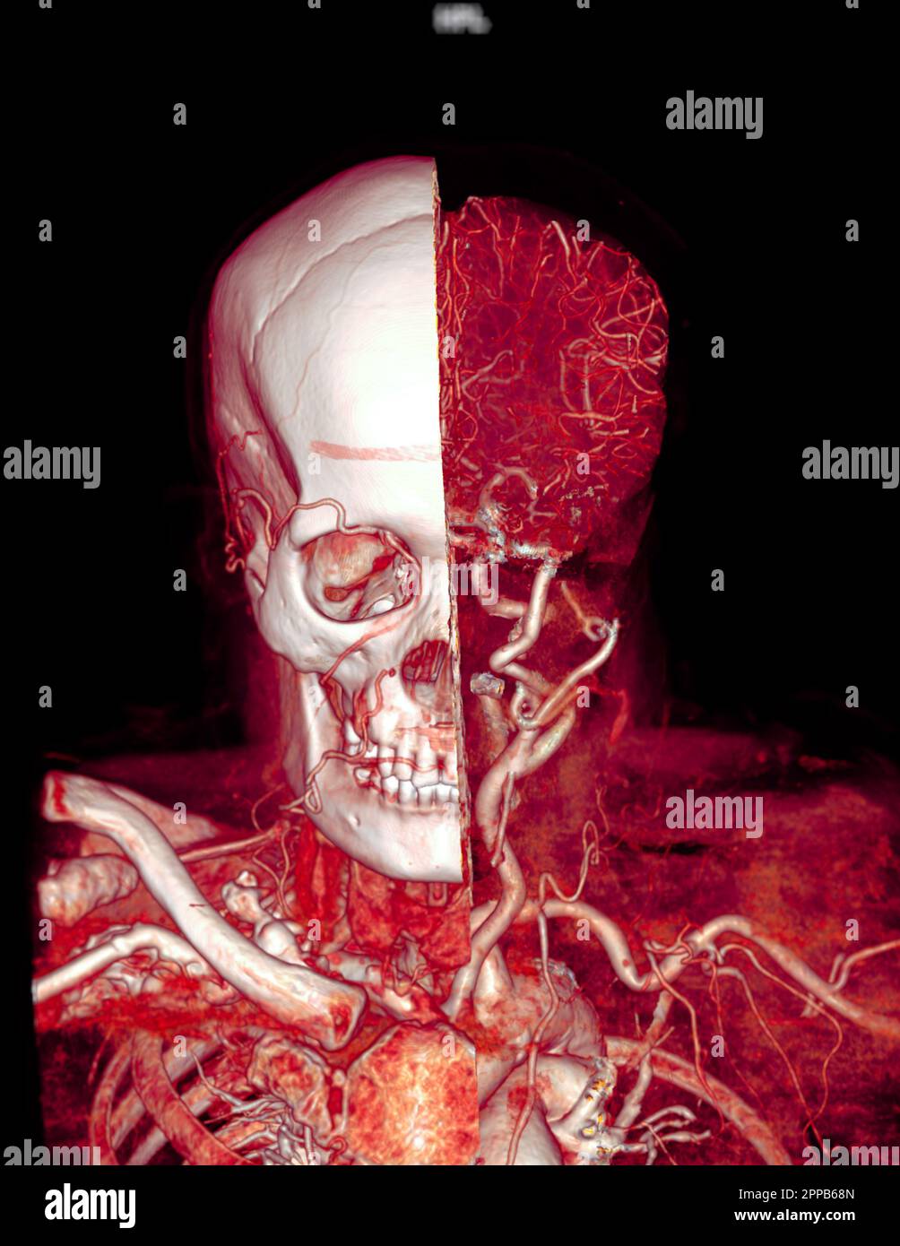CTA brain and carotid artery or CT angiography of the brain 3D
