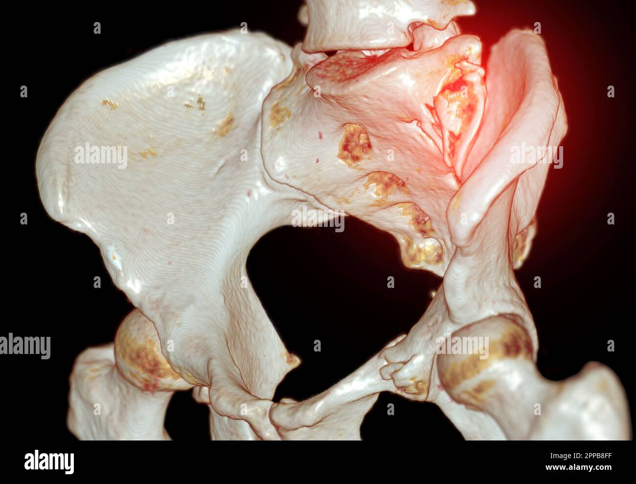 CT Scan pelvic bone with both hip joint 3D rendering  showign fracture of sacrum and superior pubic rumus. Stock Photo
