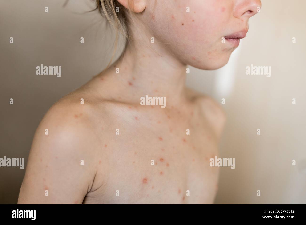 Chickenpox, varicella virus or vesicular rash on little girl body and face. Close-up Portrait of Kid with red pimples. Obscured face of child Stock Photo