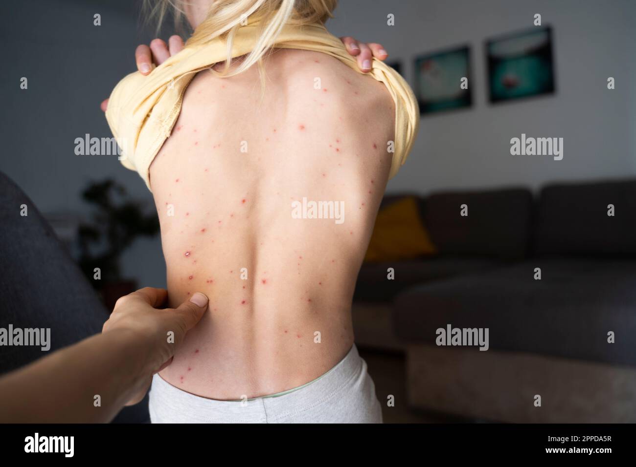 Woman touching back of girl with chickenpox Stock Photo