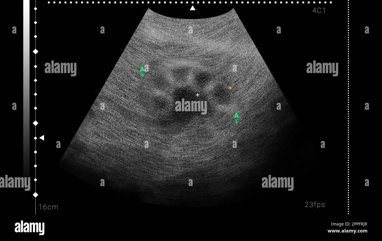 Sonogram of human kidney, illustration. Ultrasound diagnostic Stock