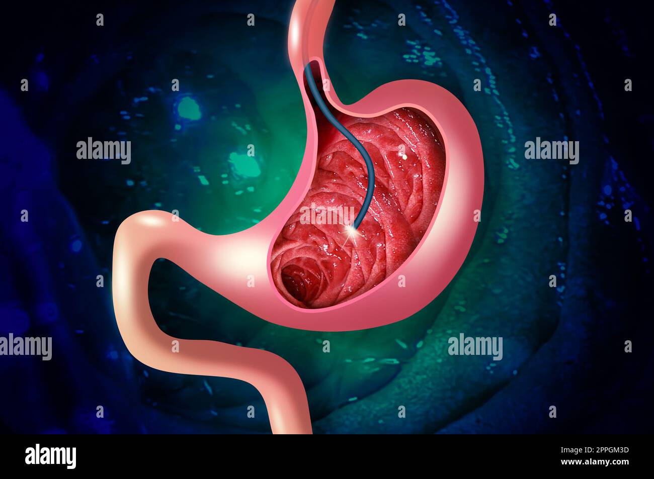 Digestive endoscopy or gastroscopy. Performing a gastroscopy procedure. Diagnostics of gastric diseases. Stomach health. Stock Photo