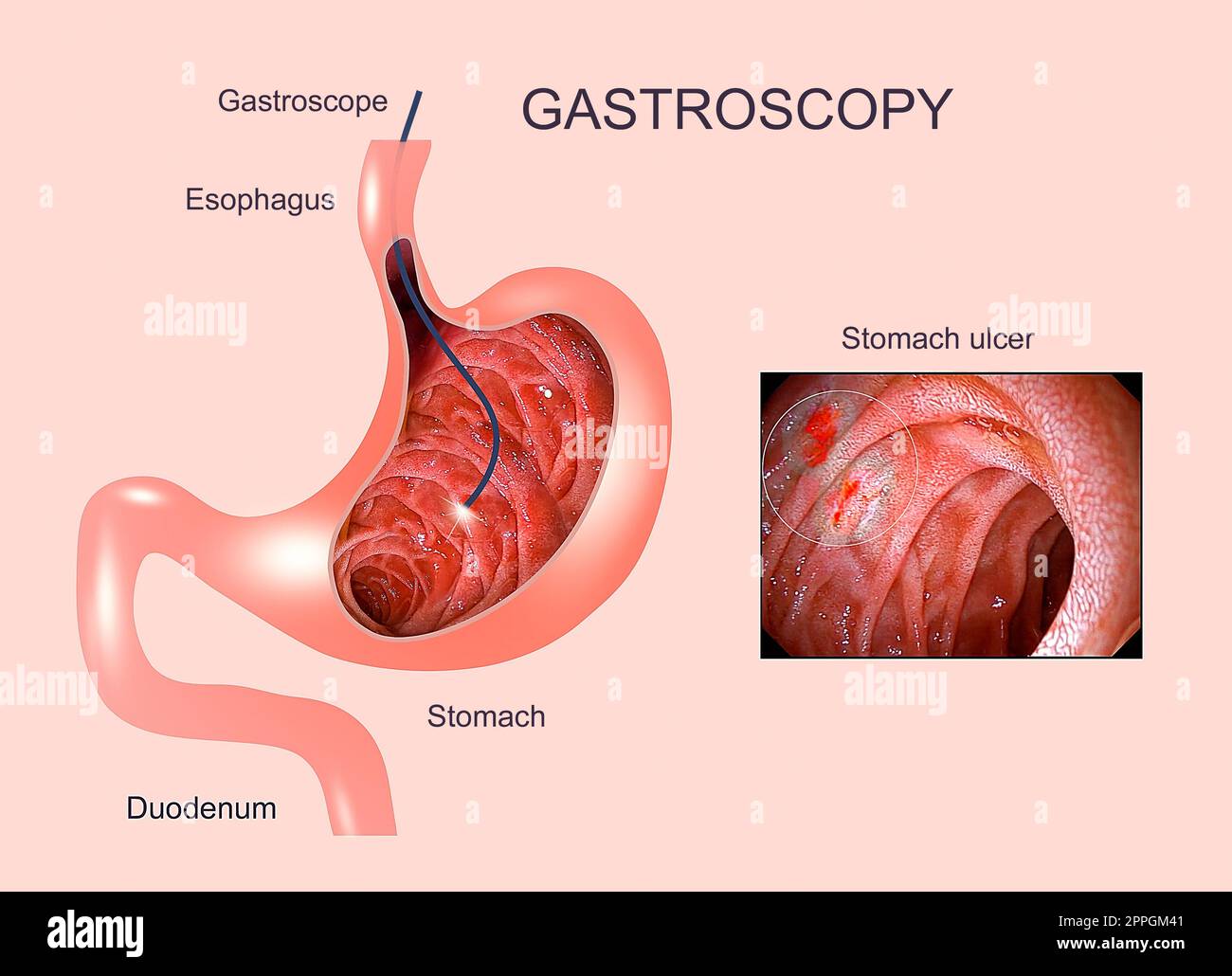 Digestive endoscopy or gastroscopy. Performing a gastroscopy procedure. Diagnostics of gastric diseases. Stomach health. Stock Photo