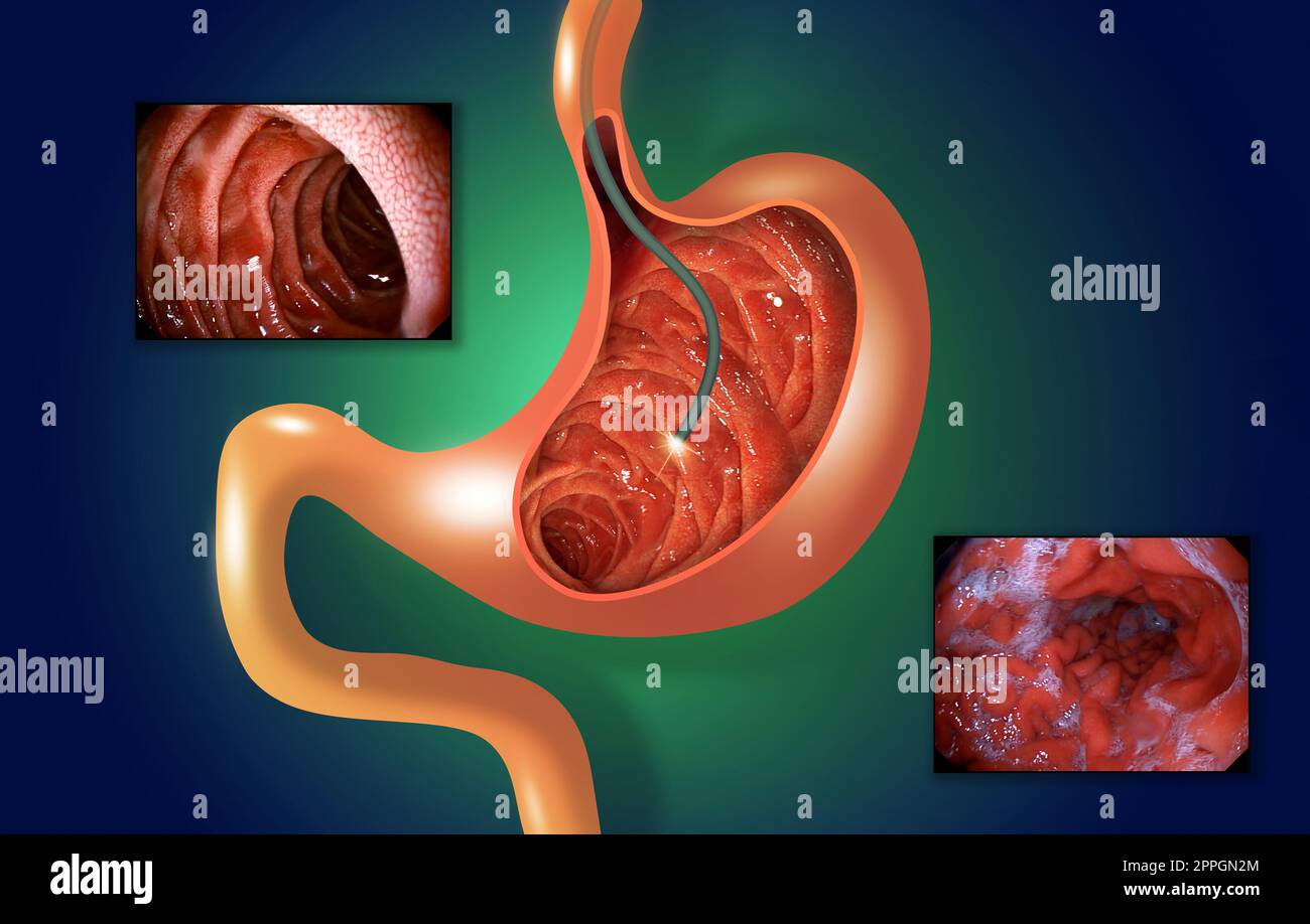 Digestive endoscopy or gastroscopy. Performing a gastroscopy procedure ...