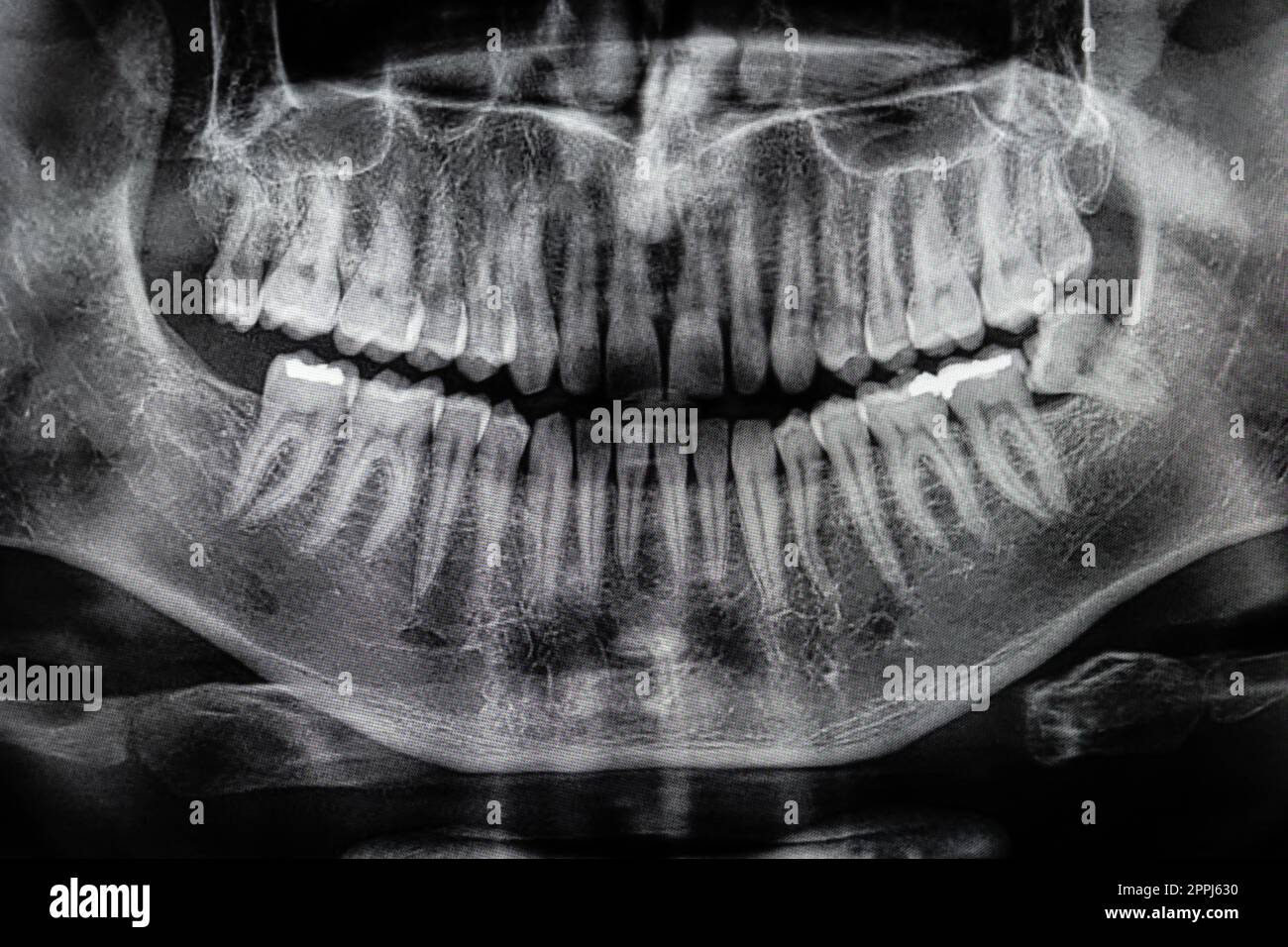Oral Xray Hi res Stock Photography And Images Alamy