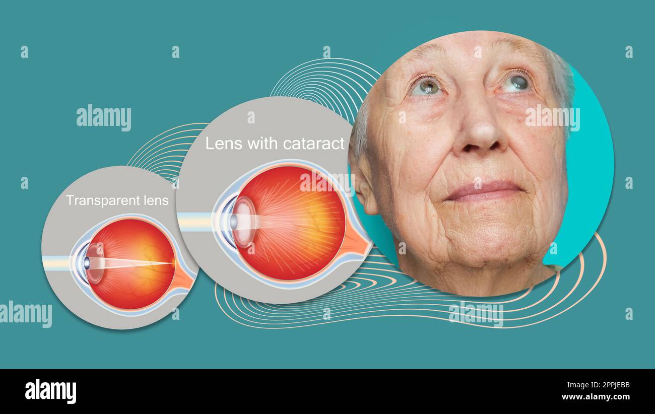 Cataract concept. Senior woman's eye, closeup and cataracts and healthy