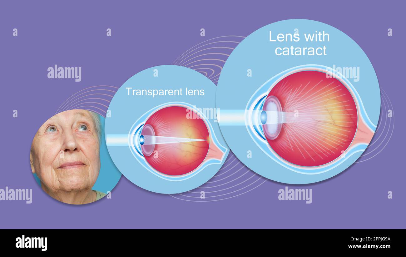 Cataract concept. Senior woman's eye, closeup Stock Photo