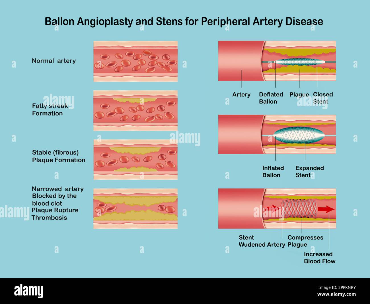 Angioplasty. Stent Implantation. Deflated balloon catheter inserted into a coronary artery