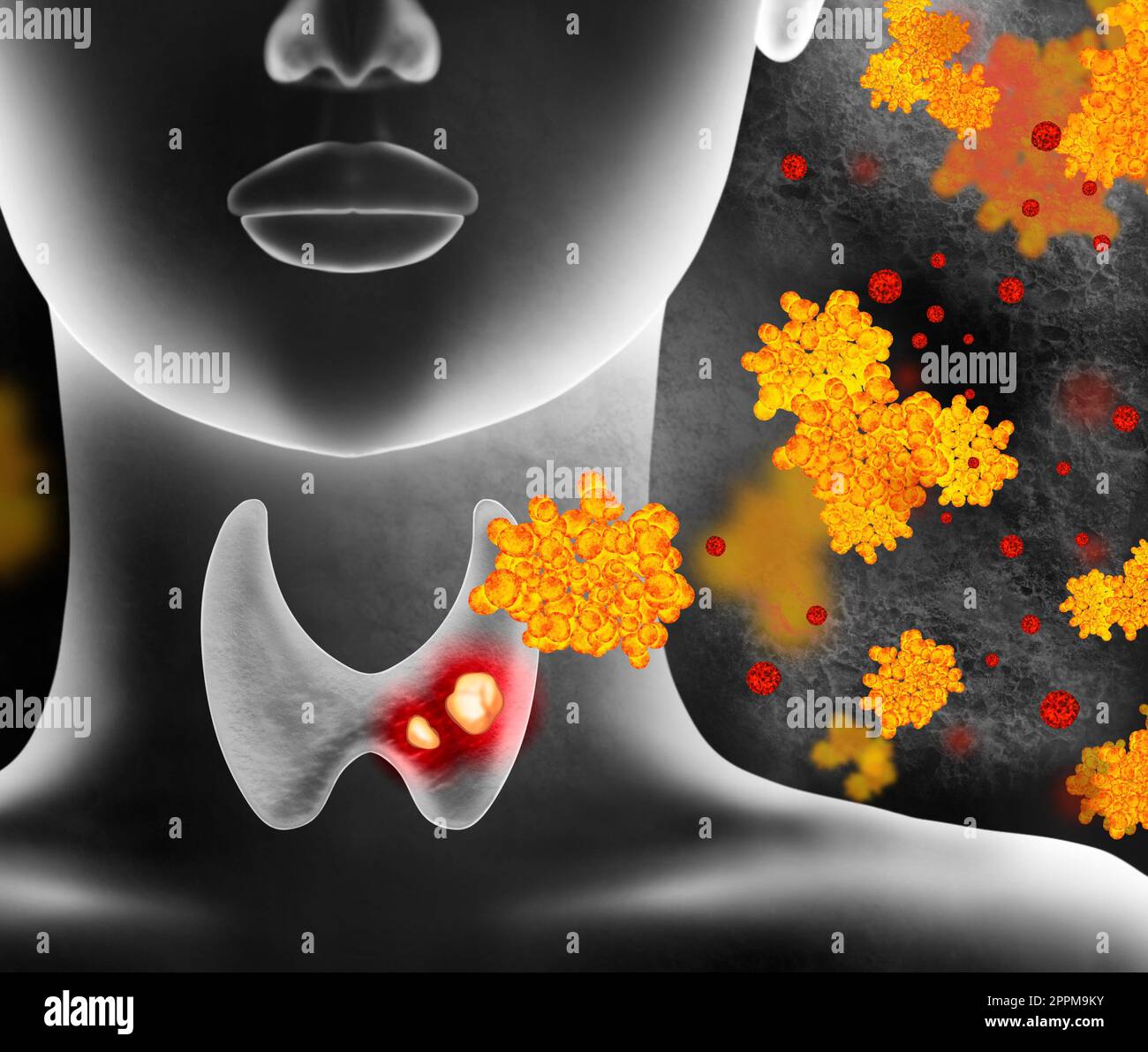 Illustration Of Human Thyroid Cancer On Color Background Stock Photo