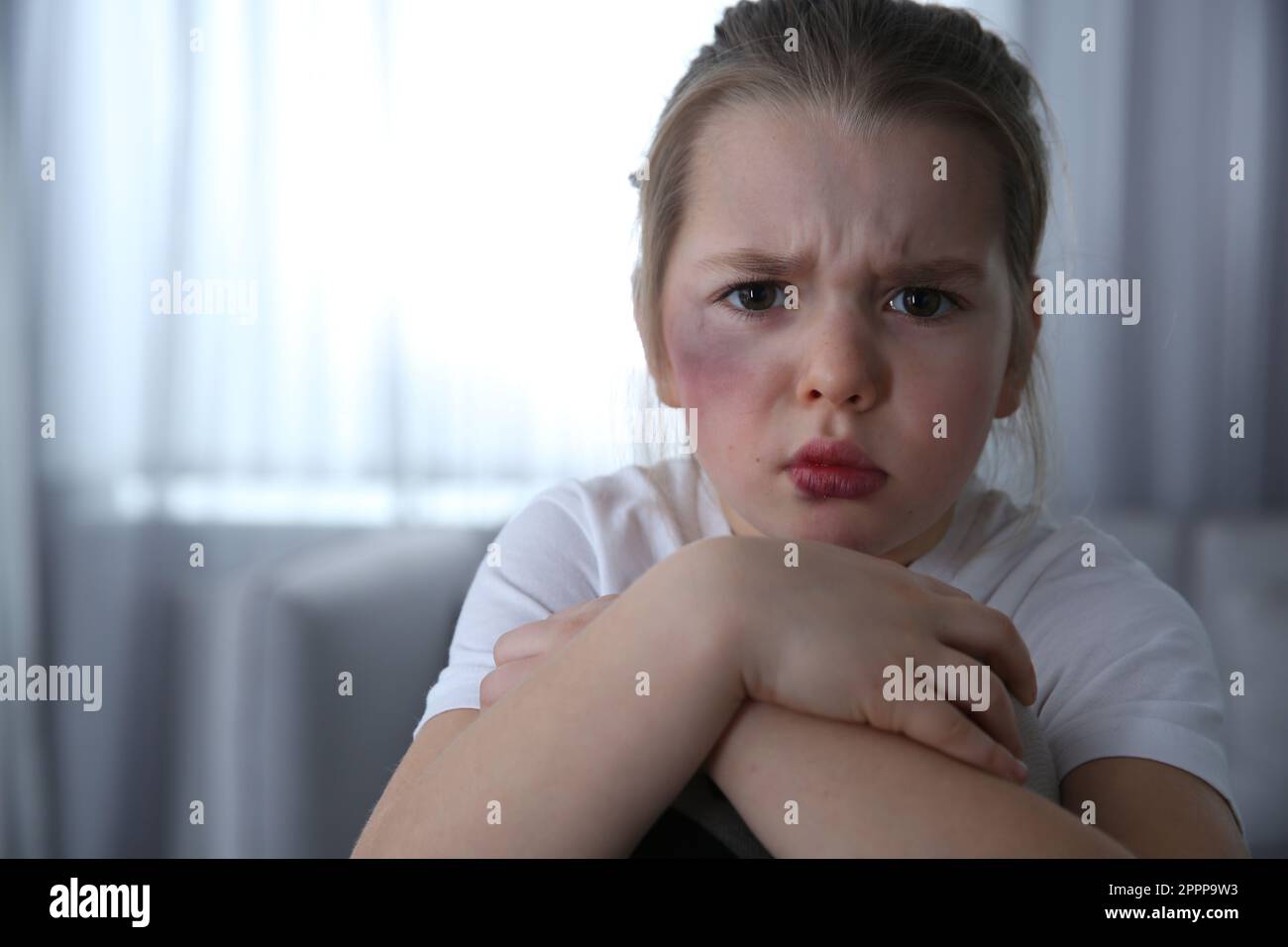 Little girl with bruises on face at home, space for text. Domestic