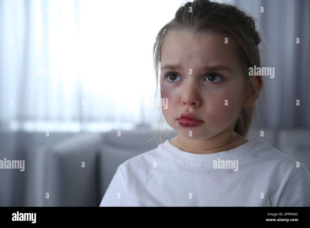 Little girl with bruises on face at home, space for text. Domestic ...