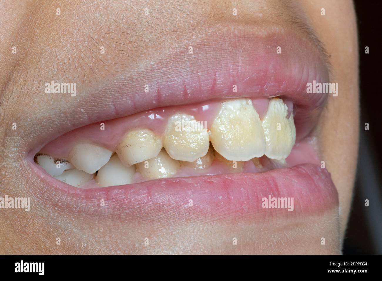 Macro of neglected baby teeth, with plaque and tartar and black fungus. Condition of poor oral hygiene with risk of bacterial infection. Stock Photo
