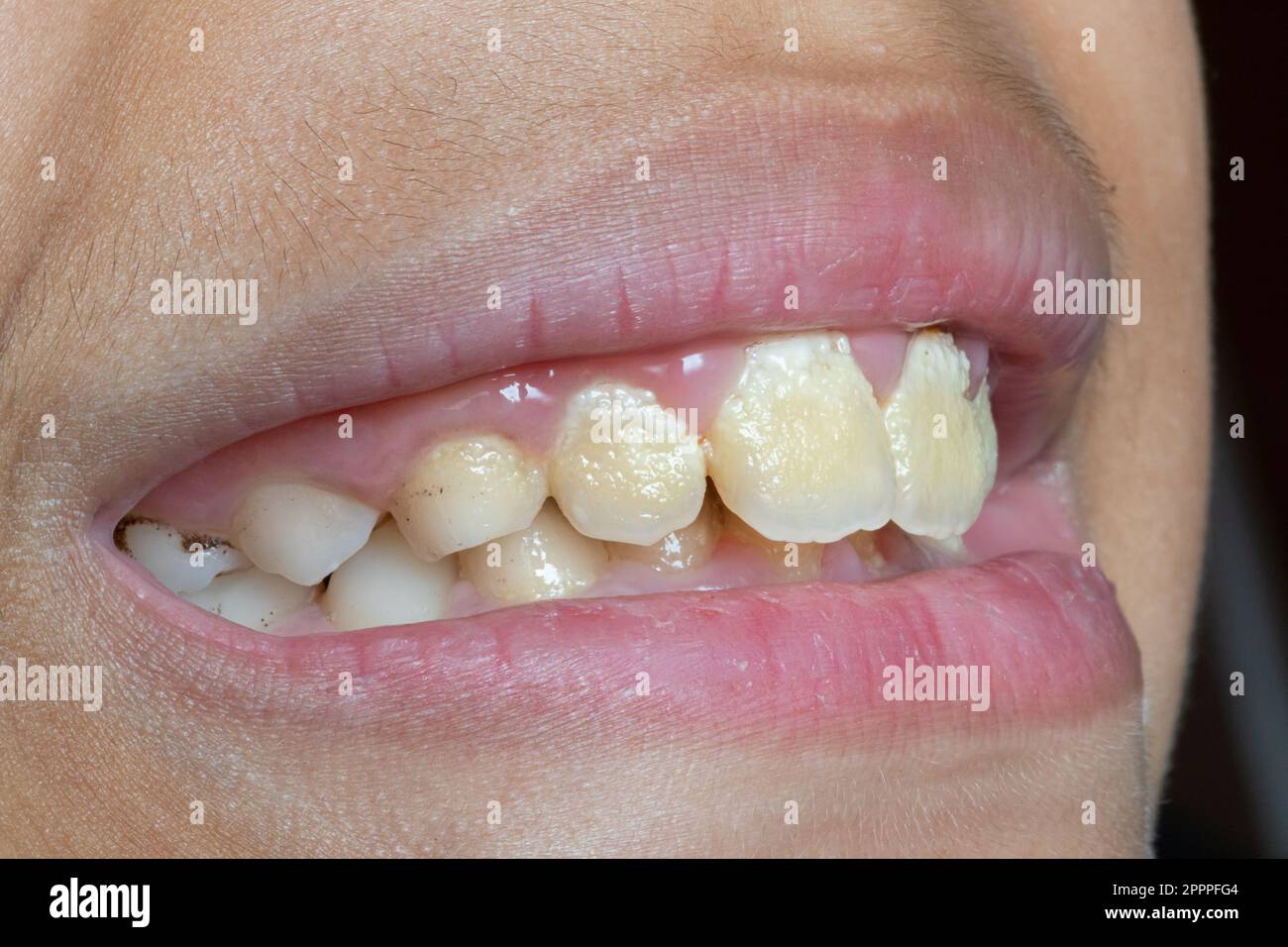 Black plaque outlet on teeth