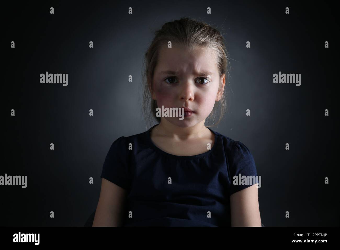 Little girl with bruises on face against dark background. Domestic