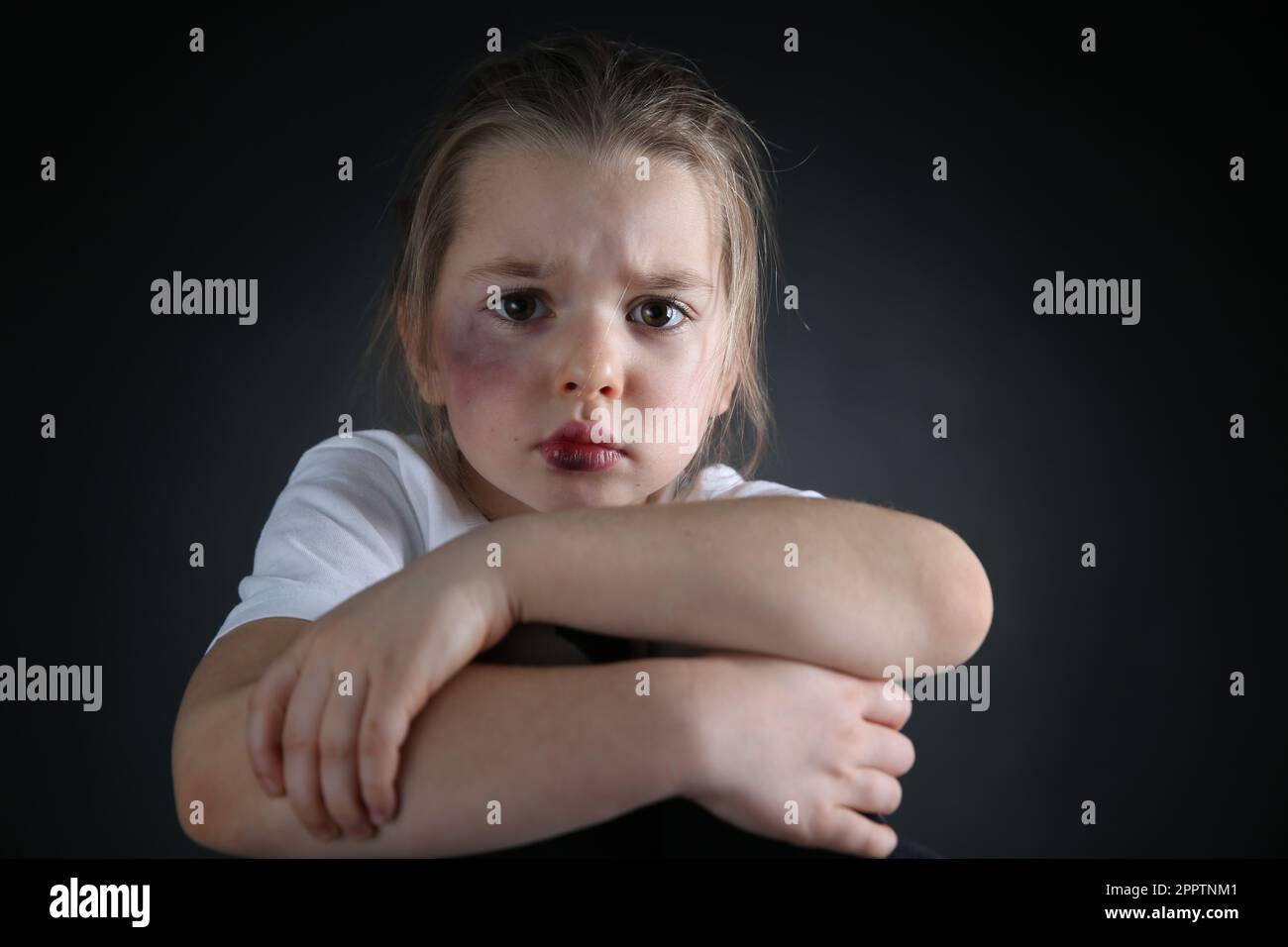 Little girl with bruises on face against dark background. Domestic