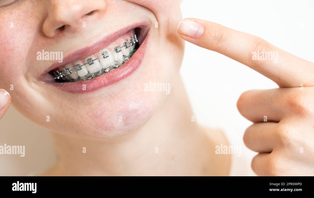 Premium Photo  Braces with blue and yellow rubber bands closeup