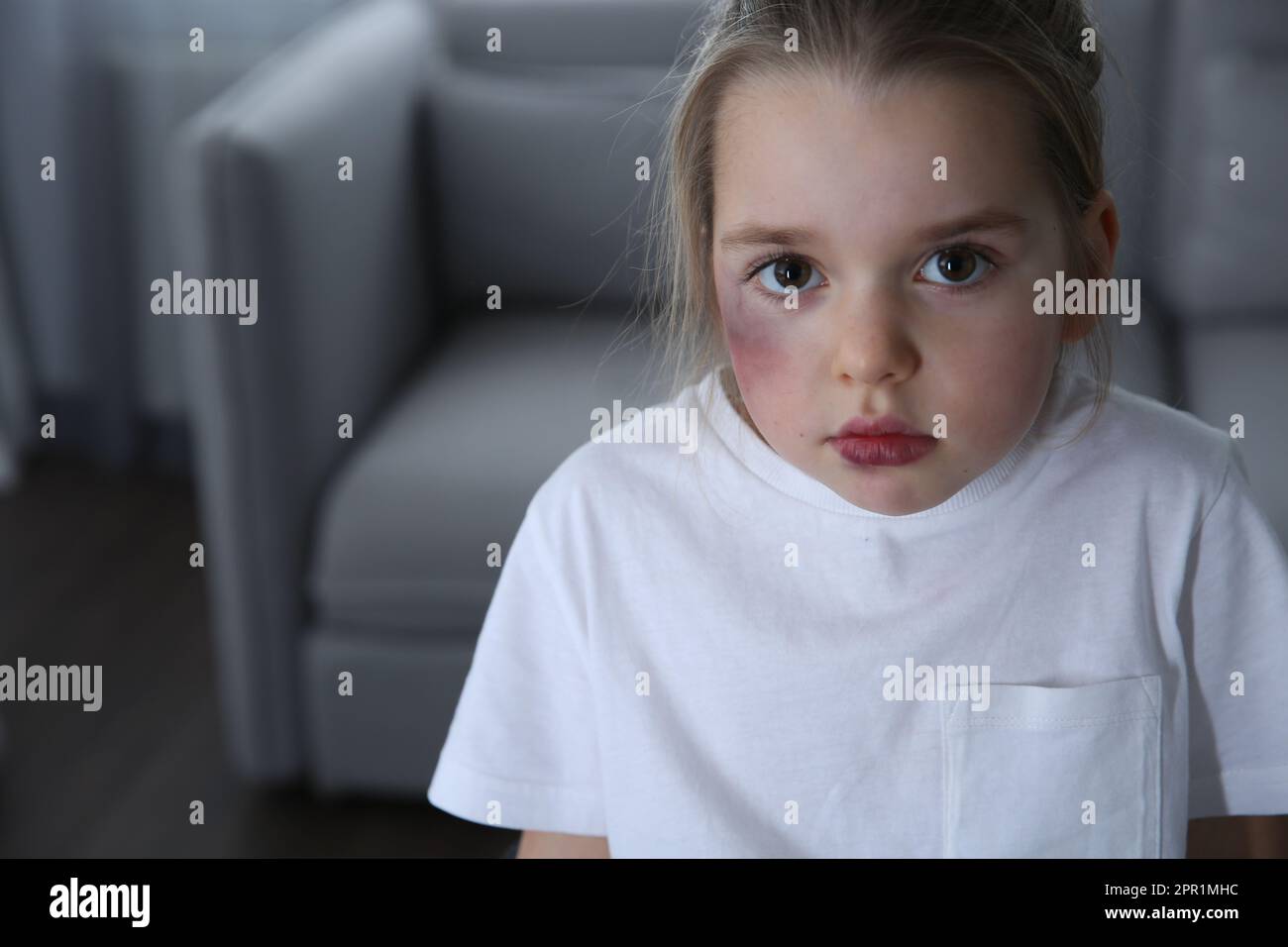 Little girl with bruises on face at home, space for text. Domestic