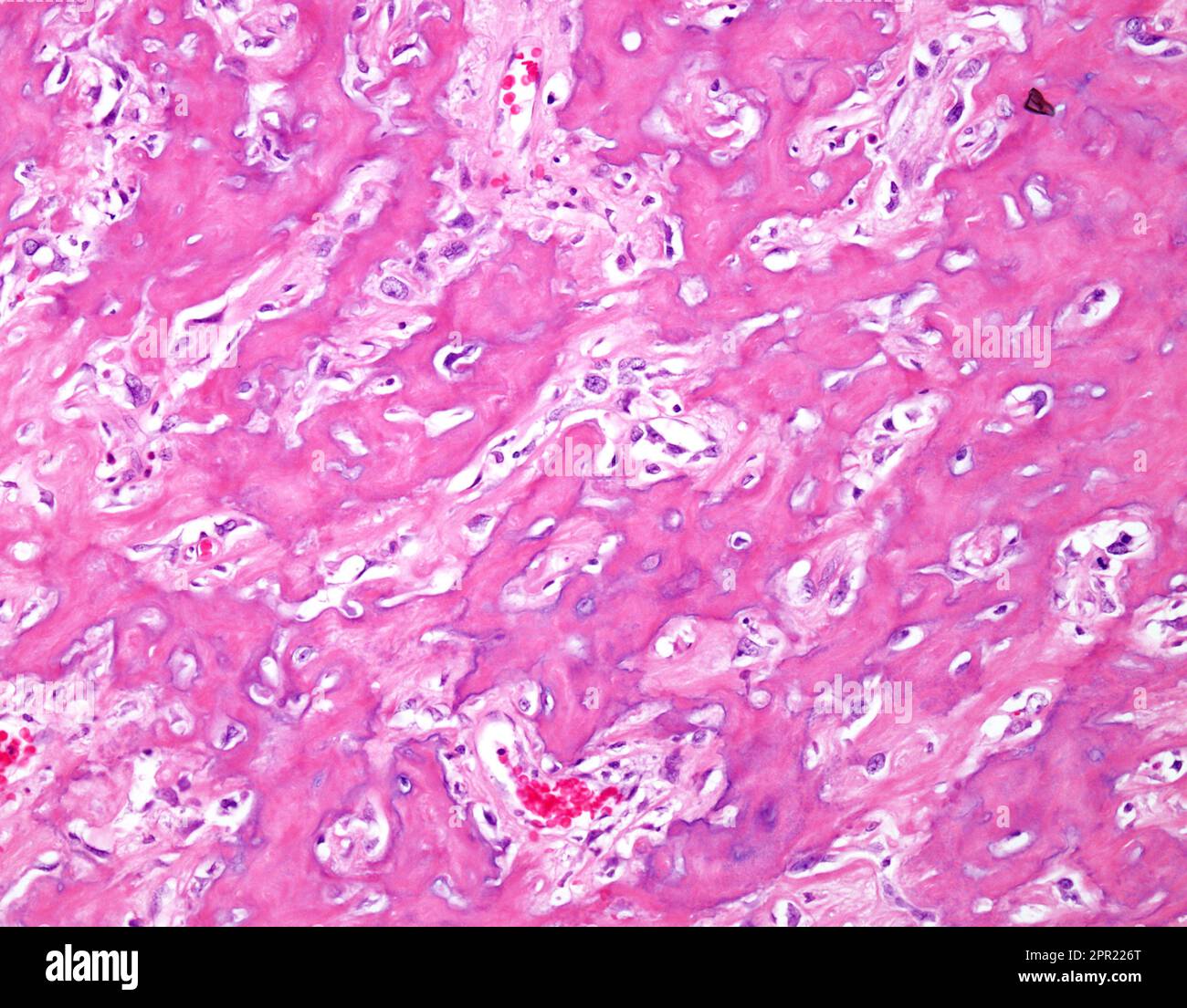 Osteoblastic osteosarcoma, light micrograph Stock Photo - Alamy