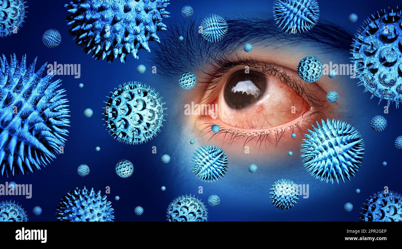 Pollen allergies symptoms and seasonal allergy or hay fever allergy and medical concept as a group of microscopic particles as eye Conjunctivitis Stock Photo