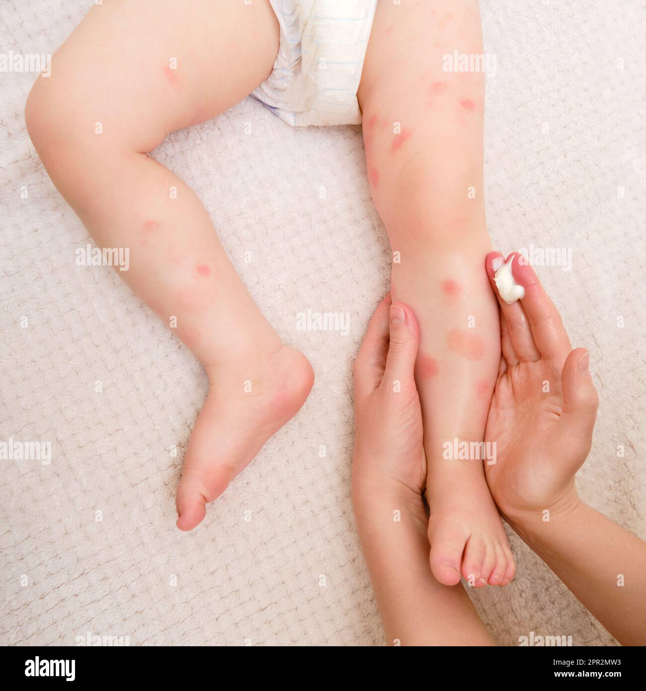 Toddler baby skin care, allergies and dermatitis. A mother woman smears red spots of allergy and atopic dermatitis on the child skin with cream. Kid a Stock Photo