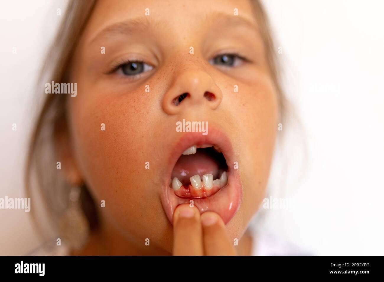 Brave, fearless girl pull off lip, show toothless mouth and fresh wound bleed after tooth extraction on white background Stock Photo