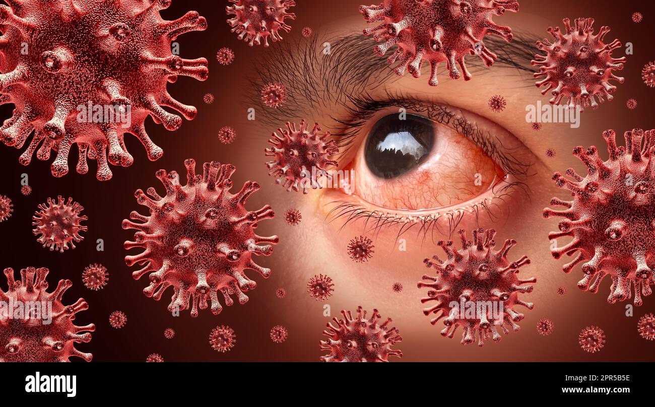 Viral Conjunctivitis highly contagious Eye Infection or infected Pink eyes as virus infections or allergic reaction and allergies as an ophthalmology Stock Photo