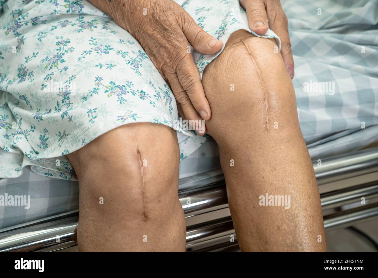 Asian senior or elderly old lady woman patient show her scars surgical total knee joint replacement Suture wound surgery arthroplasty on bed in nursing hospital ward, healthy strong medical concept. Stock Photo