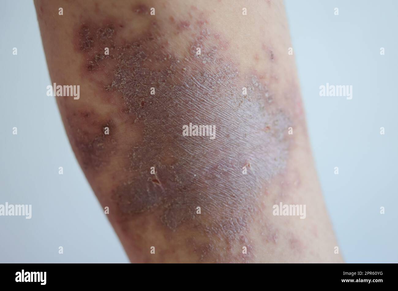 red rash girl Skin disease caused by allergies to drugs, food, chemicals, poor immune system in the lymph. Stock Photo