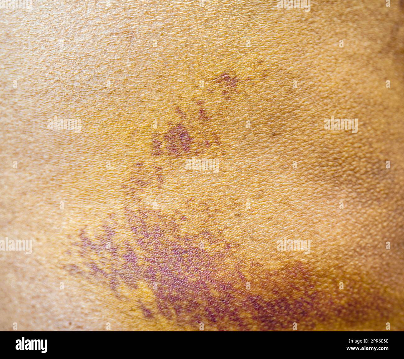 Buttock injury hi-res stock photography and images - Alamy