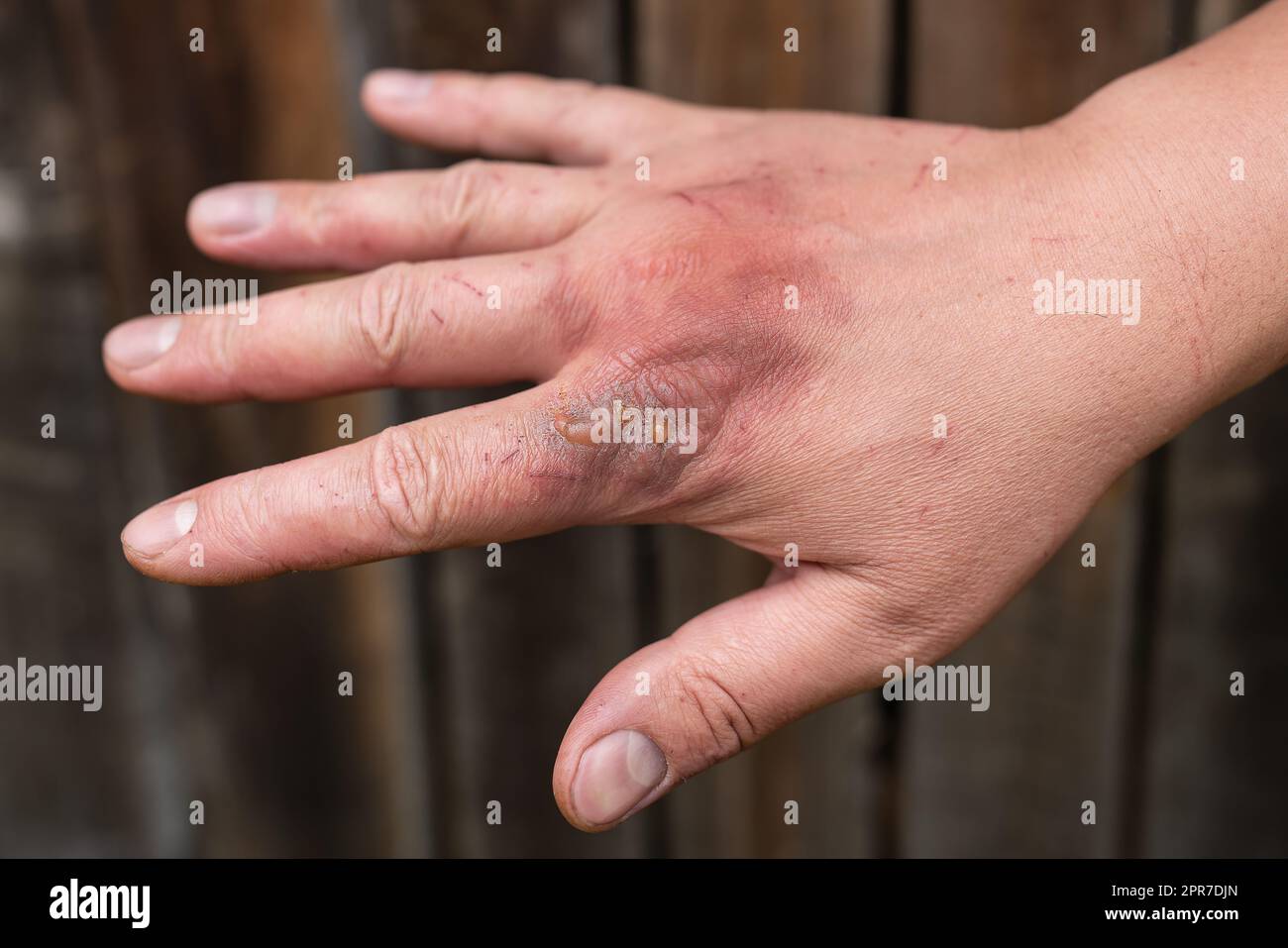 First degree skin burn. Hand burns, wounds. Hot boiling water acts on the skin. Fresh burn. Stock Photo