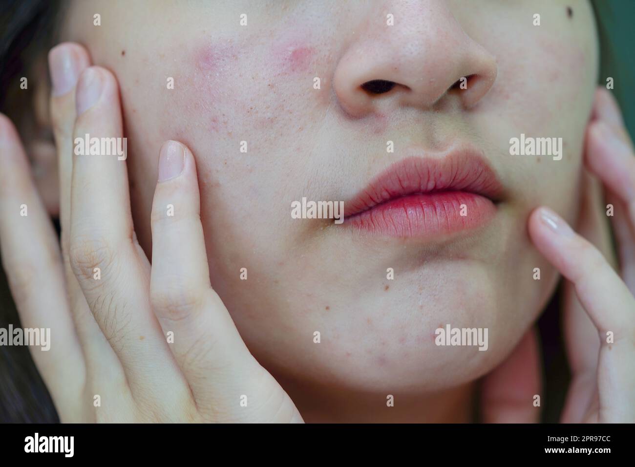 acne: Your acne keeps returning and getting worse? Here are some skin &  diet solutions by experts - The Economic Times