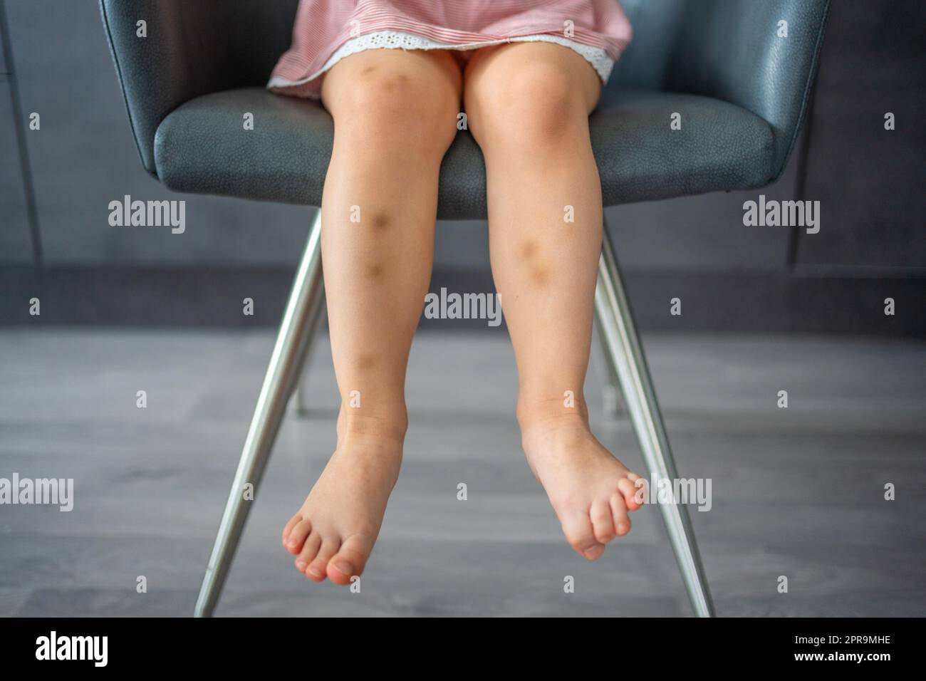 Close up of stains bruise wound on legs of little girl. Extravasation