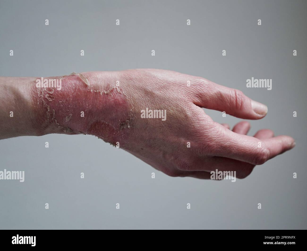 Closeup of a woman's hand with a burst blister from a boiled water