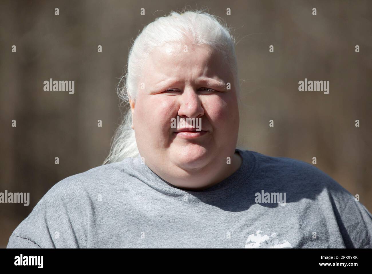 Albino person hi-res stock photography and images - Alamy