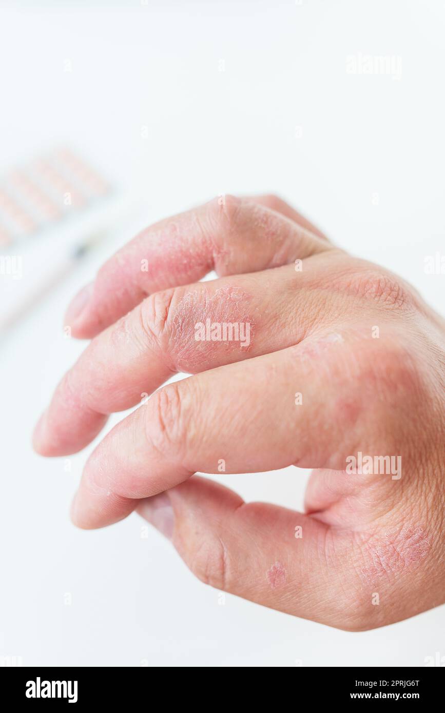 A man shows a reddening rash on his hands. The causes of itchy skin can