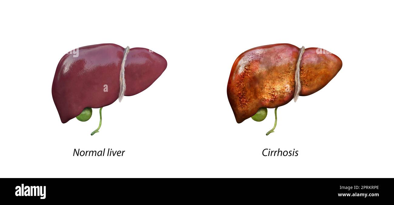 Normal liver versus liver with Cirrhosis, damaged liver, excessive