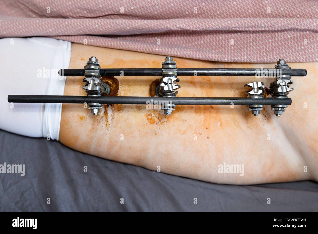 top view of external fixation device on hip and pelvic in patient with