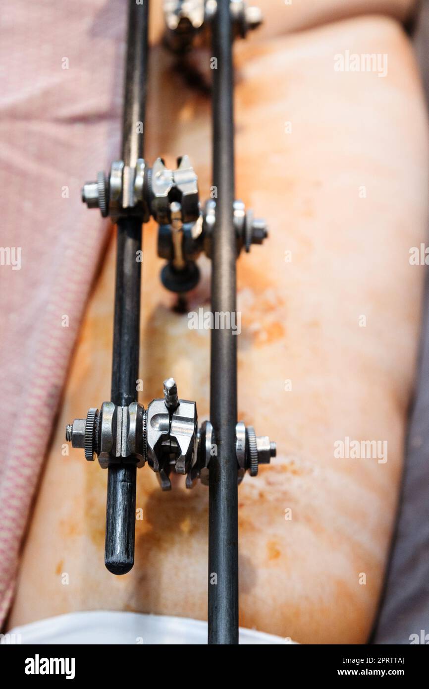 view of external fixation device on hip and pelvic in patient with