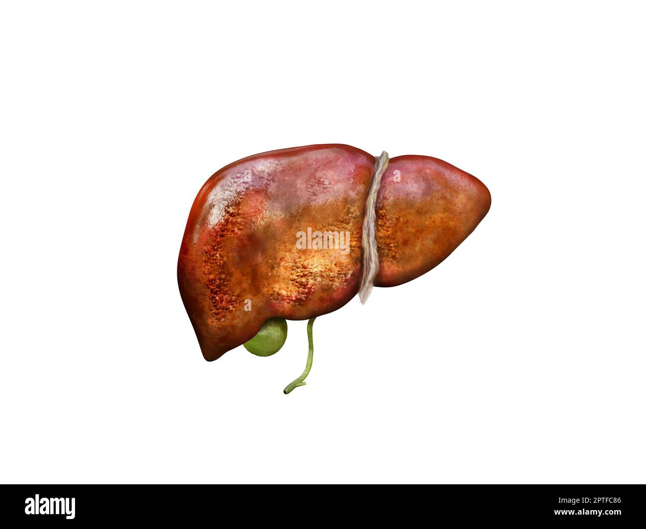Realistic illustration sick cirrhosis human livers , damaged liver
