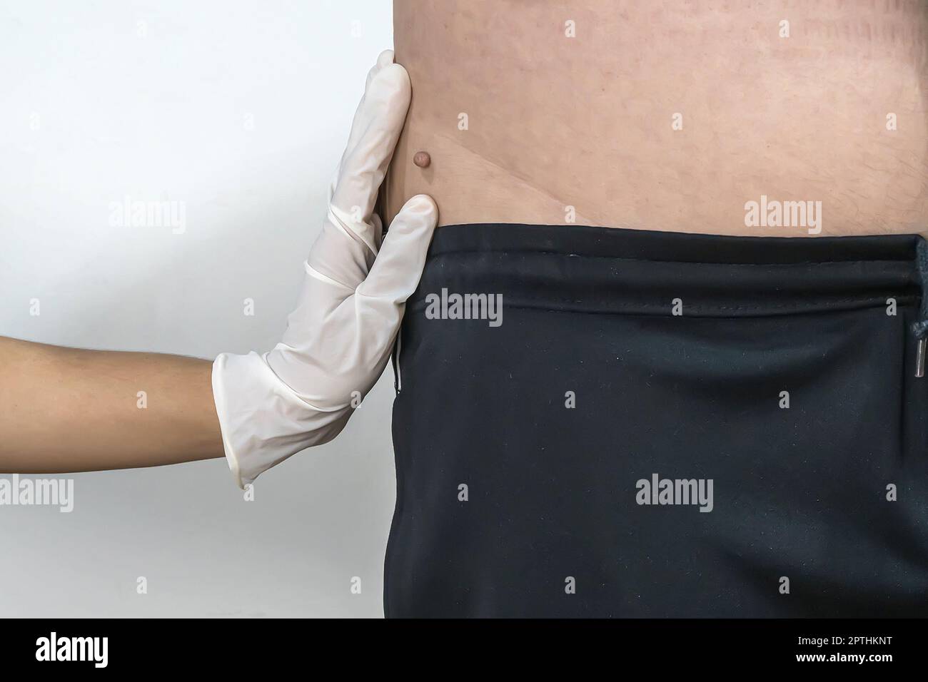 Skin tag or acrochondon or soft fibroma is a safe. It have not effect