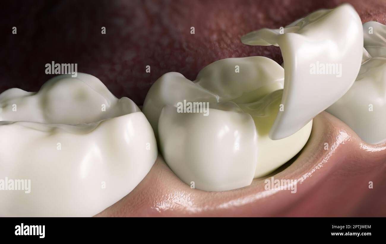 Tooth Seramic Ceramic Onlay quarter crown over a tooth- 3D Rendering Stock Photo - Alamy